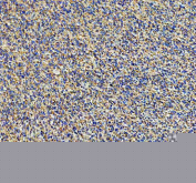 IHC staining of FFPE human glioma tissue with Ephrin Receptor B3 antibody, HRP-secondary and DAB substrate. HIER: boil tissue sections in pH8 EDTA for 20 min and allow to cool before testing.