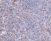 IHC staining of FFPE human glioma tissue with CXCL1 antibody. HIER: boil tissue sections in pH8 EDTA for 20 min and allow to cool before testing.