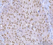 IHC staining of FFPE human urothelial carcinoma tissue with HOXD10 antibody. HIER: boil tissue sections in pH8 EDTA for 20 min and allow to cool before testing.