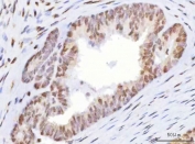 IHC staining of FFPE human mucinous adenoma of the ovary with HOXD10 antibody. HIER: boil tissue sections in pH8 EDTA for 20 min and allow to cool before testing.