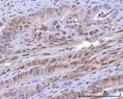 IHC staining of FFPE human rectum adenocarcinoma tissue with HOXD10 antibody. HIER: boil tissue sections in pH8 EDTA for 20 min and allow to cool before testing.