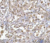 IHC staining of FFPE human lung adenocarcinoma tissue with HOXD10 antibody. HIER: boil tissue sections in pH8 EDTA for 20 min and allow to cool before testing.