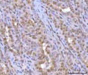 IHC staining of FFPE human thyroid papillary carcinoma tissue with HOXD10 antibody. HIER: boil tissue sections in pH8 EDTA for 20 min and allow to cool before testing.