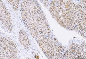 IHC staining of FFPE human liver cancer tissue with CBP80 antibody. HIER: boil tissue sections in pH8 EDTA for 20 min and allow to cool before testing.