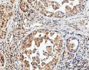 IHC staining of FFPE human lung adenocarcinoma tissue with CBP80 antibody. HIER: boil tissue sections in pH8 EDTA for 20 min and allow to cool before testing.