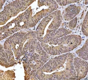 IHC staining of FFPE human colorectal adenocarcinoma tissue with CBP80 antibody. HIER: boil tissue sections in pH8 EDTA for 20 min and allow to cool before testing.