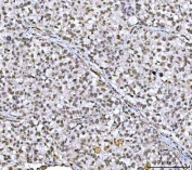 IHC staining of FFPE human lung cancer tissue with CBP80 antibody. HIER: boil tissue sections in pH8 EDTA for 20 min and allow to cool before testing.