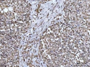 IHC staining of FFPE human ovarian cancer tissue with CBP80 antibody. HIER: boil tissue sections in pH8 EDTA for 20 min and allow to cool before testing.