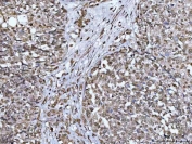 IHC staining of FFPE human ovarian cancer tissue with CBP80 antibody. HIER: boil tissue sections in pH8 EDTA for 20 min and allow to cool before testing.