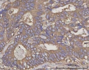 IHC staining of FFPE human rectum adenocarcinoma tissue with NDUFA4 antibody. HIER: boil tissue sections in pH8 EDTA for 20 min and allow to cool before testing.
