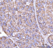 IHC staining of FFPE human liver cancer tissue with PFKFB1 antibody. HIER: boil tissue sections in pH8 EDTA for 20 min and allow to cool before testing.
