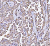 IHC staining of FFPE human lung adenocarcinoma tissue with PFKFB1 antibody. HIER: boil tissue sections in pH8 EDTA for 20 min and allow to cool before testing.