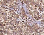 IHC staining of FFPE human urothelial carcinoma tissue with PPP3CB antibody. HIER: boil tissue sections in pH8 EDTA for 20 min and allow to cool before testing.