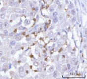 IHC staining of FFPE human lung adenocarcinoma tissue with PRTN3 antibody. HIER: boil tissue sections in pH8 EDTA for 20 min and allow to cool before testing.