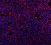 Immunofluorescent staining of FFPE human thyroid cancer with Prosaposin antibody (red) and DAPI nuclear stain (blue). HIER: steam section in pH8 EDTA buffer for 20 min.