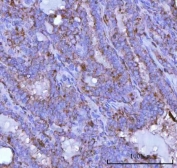 IHC staining of FFPE human thyroid papillary carcinoma tissue with Prosaposin antibody. HIER: boil tissue sections in pH8 EDTA for 20 min and allow to cool before testing.