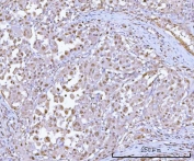 IHC staining of FFPE human lung adenocarcinoma tissue with Proteasome 20S alpha 1 antibody. HIER: boil tissue sections in pH8 EDTA for 20 min and allow to cool before testing.