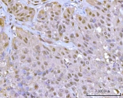 IHC staining of FFPE human urothelial carcinoma tissue with Proteasome 20S alpha 1 antibody. HIER: boil tissue sections in pH8 EDTA for 20 min and allow to cool before testing.
