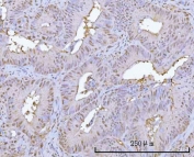 IHC staining of FFPE human rectum adenocarcinoma tissue with Proteasome 20S alpha 1 antibody. HIER: boil tissue sections in pH8 EDTA for 20 min and allow to cool before testing.