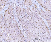IHC staining of FFPE human urothelial carcinoma tissue with Proteasome subunit beta type 9 antibody. HIER: boil tissue sections in pH8 EDTA for 20 min and allow to cool before testing.
