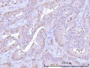 IHC staining of FFPE human rectum adenocarcinoma tissue with Proteasome subunit beta type 9 antibody. HIER: boil tissue sections in pH8 EDTA for 20 min and allow to cool before testing.