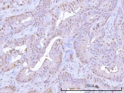 IHC staining of FFPE human rectum adenocarcinoma tissue with Proteasome subunit beta type 9 antibody. HIER: boil tissue sections in pH8 EDTA for 20 min and allow to cool before testing.