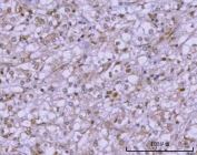 IHC staining of FFPE human glioblastoma tissue with PSMC4 antibody. HIER: boil tissue sections in pH8 EDTA for 20 min and allow to cool before testing.