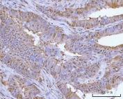 IHC staining of FFPE human rectum adenocarcinoma tissue with PSMC4 antibody. HIER: boil tissue sections in pH8 EDTA for 20 min and allow to cool before testing.