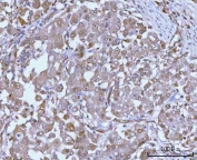 IHC staining of FFPE human lung adenocarcinoma tissue with PSMC4 antibody. HIER: boil tissue sections in pH8 EDTA for 20 min and allow to cool before testing.