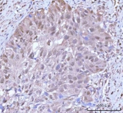 IHC staining of FFPE human urothelial carcinoma tissue with PSMC4 antibody. HIER: boil tissue sections in pH8 EDTA for 20 min and allow to cool before testing.