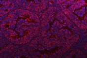 Immunofluorescent staining of FFPE human intestinal cancer tissue with PSMD4 antibody (red) and DAPI nuclear stain (blue). HIER: steam section in pH8 EDTA buffer for 20 min.