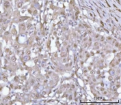 IHC staining of FFPE human lung adenocarcinoma tissue with PSMD4 antibody. HIER: boil tissue sections in pH8 EDTA for 20 min and allow to cool before testing.