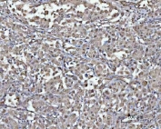 IHC staining of FFPE human lung cancer tissue with PSMD4 antibody. HIER: boil tissue sections in pH8 EDTA for 20 min and allow to cool before testing.
