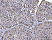 IHC staining of FFPE human liver cancer tissue with PSMD4 antibody. HIER: boil tissue sections in pH8 EDTA for 20 min and allow to cool before testing.