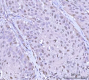 IHC staining of FFPE human urothelial carcinoma tissue with PSMD4 antibody. HIER: boil tissue sections in pH8 EDTA for 20 min and allow to cool before testing.