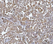 IHC staining of FFPE human lung cancer tissue with PYCR1 antibody. HIER: boil tissue sections in pH8 EDTA for 20 min and allow to cool before testing.