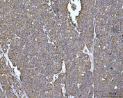 IHC staining of FFPE human ovarian cancer tissue with PYCR1 antibody. HIER: boil tissue sections in pH8 EDTA for 20 min and allow to cool before testing.