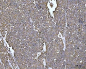 IHC staining of FFPE human ovarian cancer tissue with PYCR1 antibody. HIER: boil tissue sections in pH8 EDTA for 20 min and allow to cool before testing.