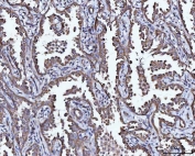 IHC staining of FFPE human lung cancer tissue with MIP-5 antibody. HIER: boil tissue sections in pH8 EDTA for 20 min and allow to cool before testing.