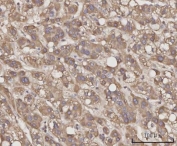 IHC staining of FFPE human liver cancer tissue with C-C motif chemokine 23 antibody. HIER: boil tissue sections in pH8 EDTA for 20 min and allow to cool before testing.