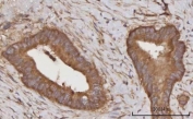 IHC staining of FFPE human rectum adenocarcinoma tissue with C-C motif chemokine 23 antibody. HIER: boil tissue sections in pH8 EDTA for 20 min and allow to cool before testing.