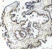 IHC staining of FFPE human ovarian cancer tissue with TP53BP1 antibody, HRP-secondary and DAB substrate. HIER: boil tissue sections in pH8 EDTA for 20 min and allow to cool before testing.