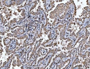 IHC staining of FFPE human lung cancer tissue with VDAC1 antibody. HIER: boil tissue sections in pH8 EDTA for 20 min and allow to cool before testing.