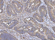 IHC staining of FFPE human colorectal adenocarcinoma tissue with VDAC1 antibody. HIER: boil tissue sections in pH8 EDTA for 20 min and allow to cool before testing.