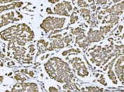 IHC staining of FFPE human breast cancer tissue with VDAC1 antibody. HIER: boil tissue sections in pH8 EDTA for 20 min and allow to cool before testing.