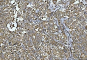 IHC staining of FFPE human urothelial carcinoma tissue with squamous differentiation with VDAC1 antibody. HIER: boil tissue sections in pH8 EDTA for 20 min and allow to cool before testing.