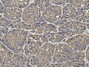IHC staining of FFPE human liver cancer tissue with VDAC1 antibody. HIER: boil tissue sections in pH8 EDTA for 20 min and allow to cool before testing.