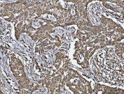 IHC staining of FFPE human lymphadenoma tissue with VDAC1 antibody. HIER: boil tissue sections in pH8 EDTA for 20 min and allow to cool before testing.