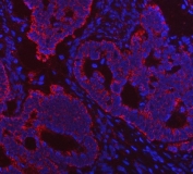 Immunofluorescent staining of FFPE human intestinal cancer tissue with VDAC1 antibody (red) and DAPI nuclear stain (blue). HIER: steam section in pH8 EDTA buffer for 20 min.