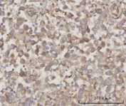 IHC staining of FFPE human testicular seminoma tissue with PRDM2 antibody. HIER: boil tissue sections in pH8 EDTA for 20 min and allow to cool before testing.